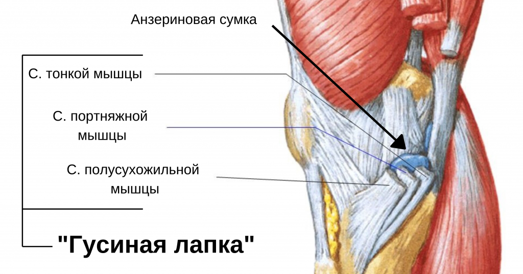 бурсит «гусиной лапки»