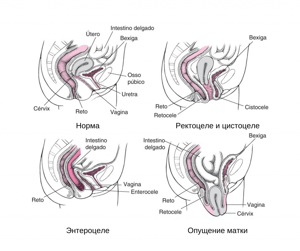 опущение органов малого таза