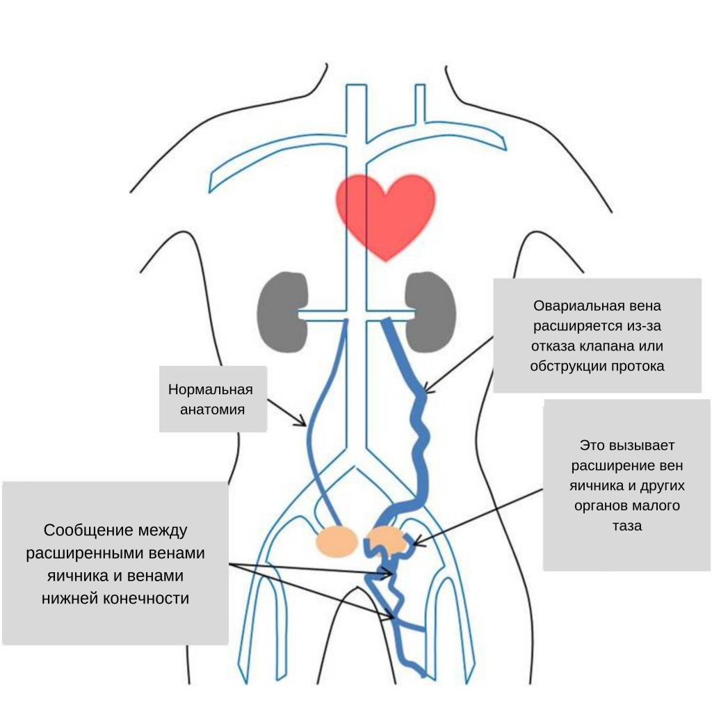 синдром тазового венозного полнокровия