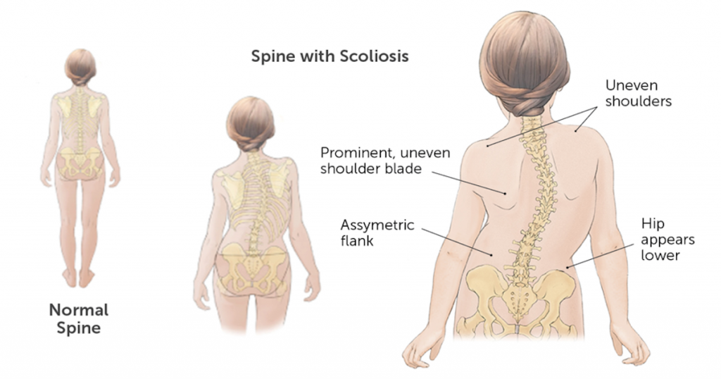 Сколиоз: виды, причины, лечение