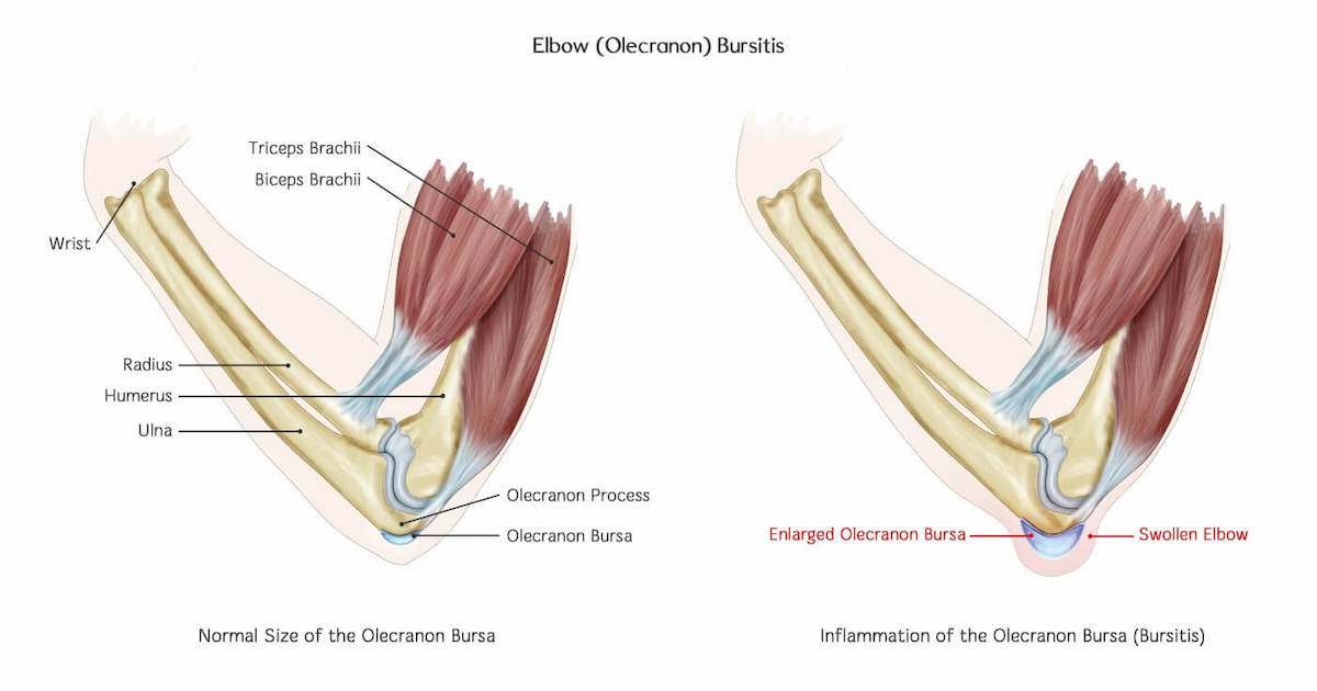 Бурсит локтевого отростка