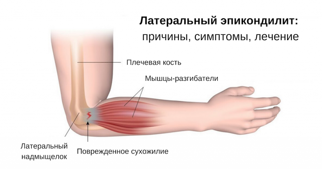 латеральный эпикондилит