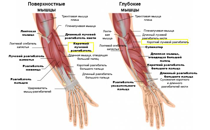 латеральный эпикондилит