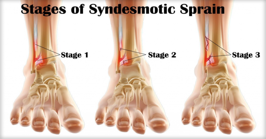 растяжение синдесмоза голеностопного сустава