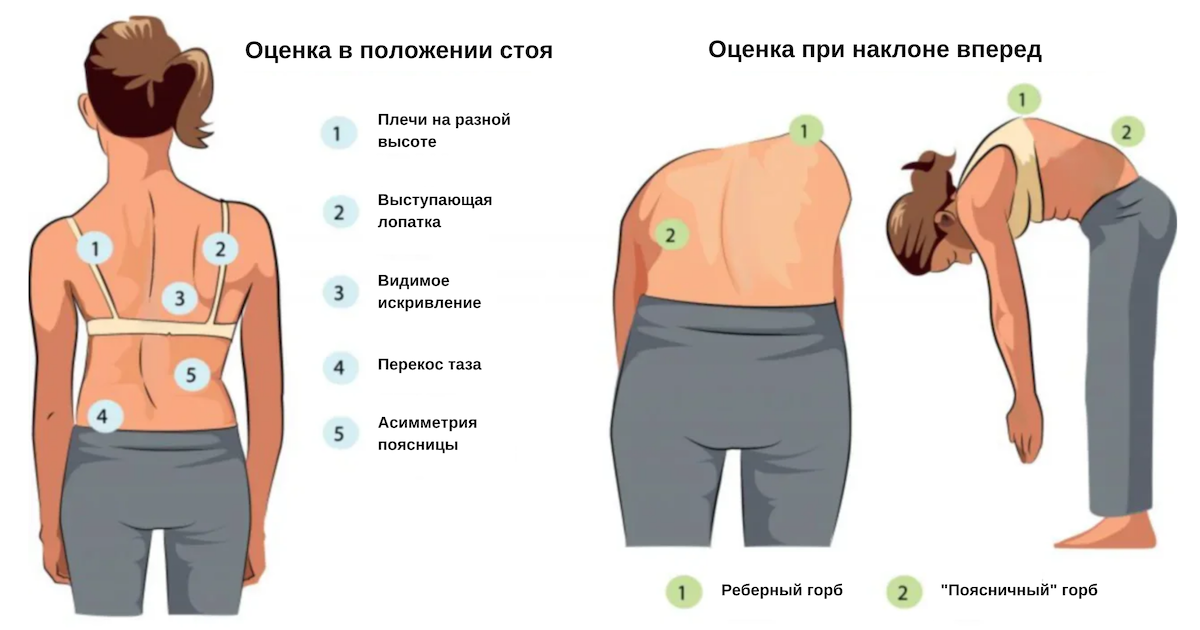 Тест Адамса (скрининг-тест на сколиоз)