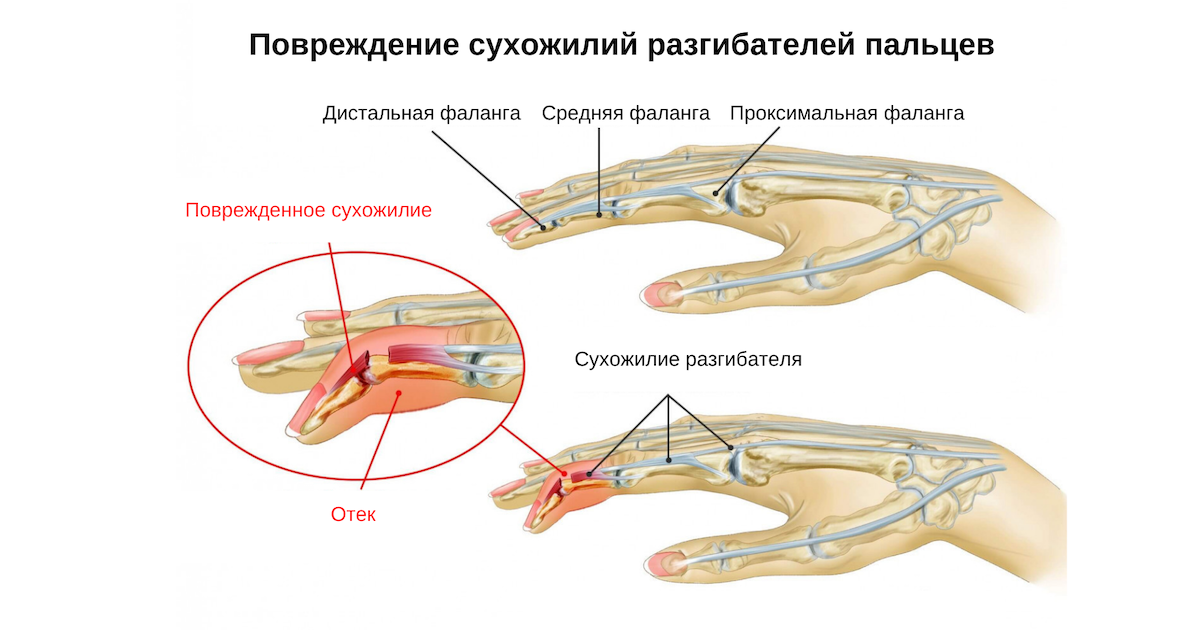 Повреждение сухожилий разгибателей пальцев и кисти