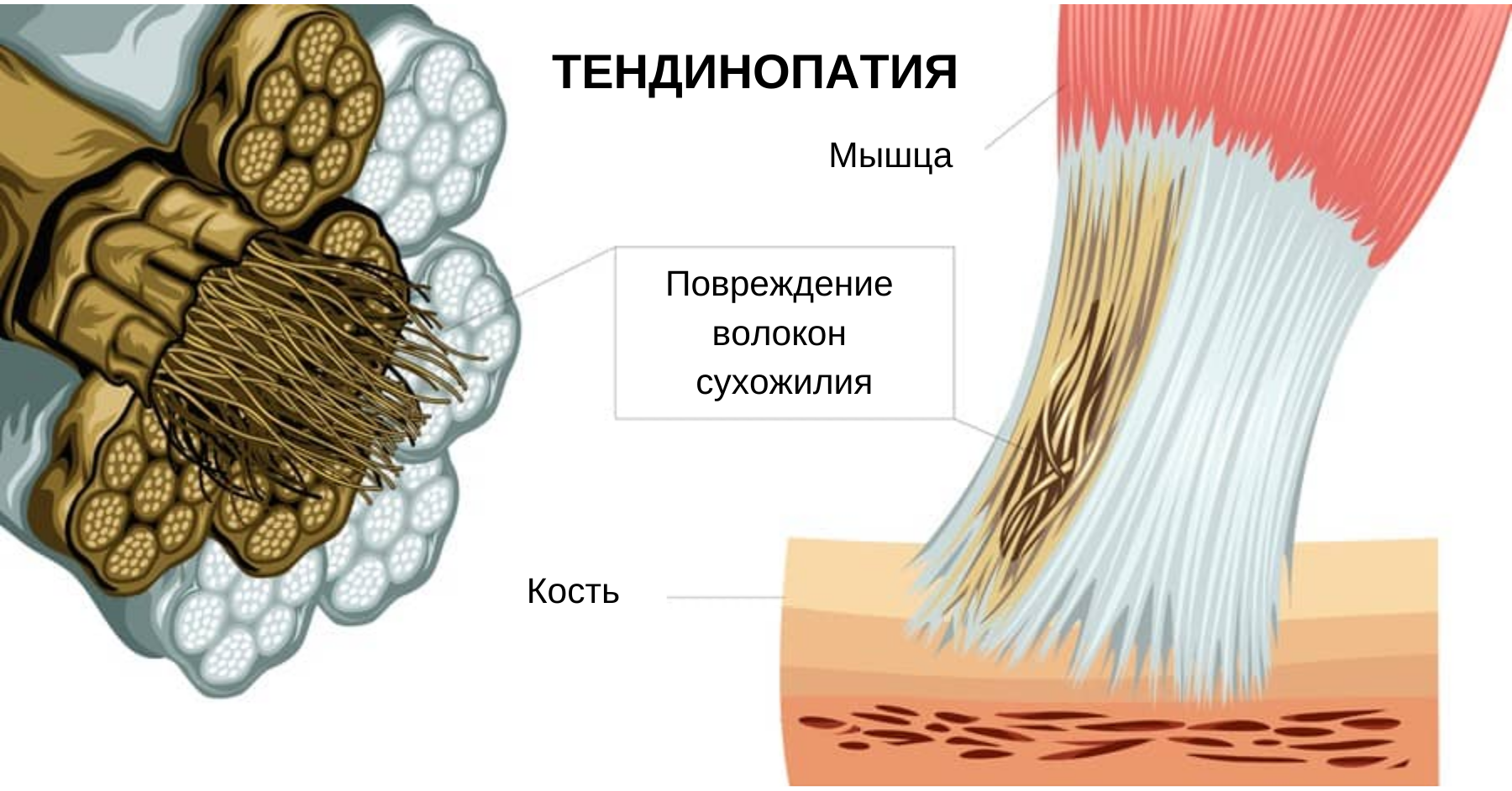 Тендинопатии: работа со сложными случаями