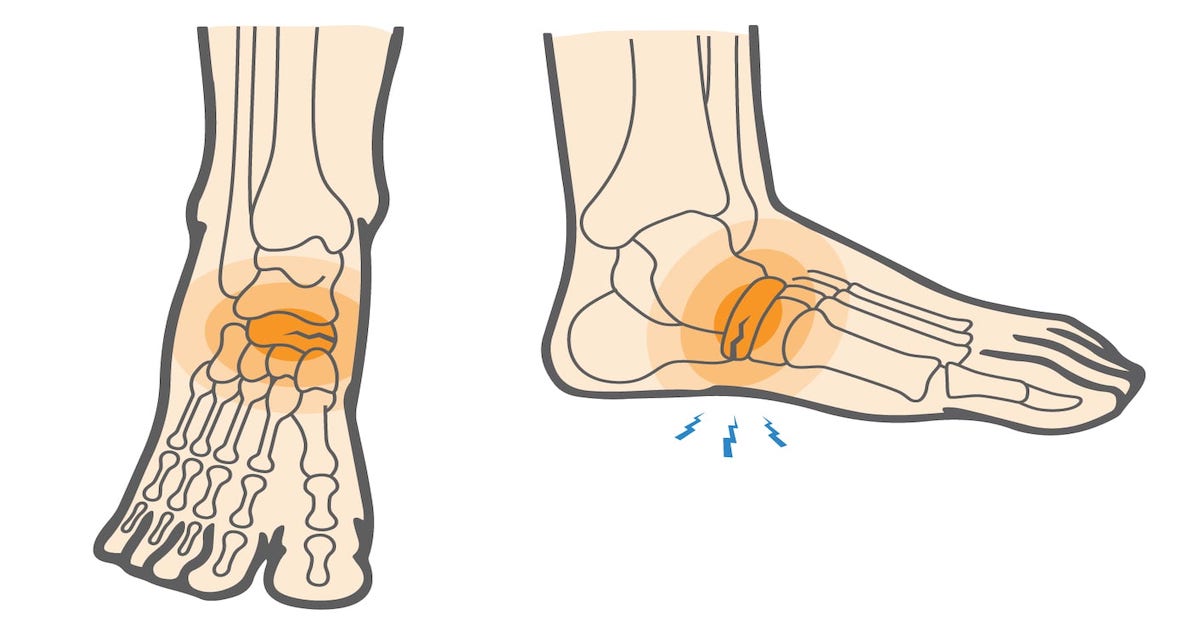 Стрессовые переломы голени и стопы