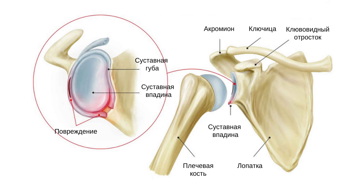 Повреждение Банкарта