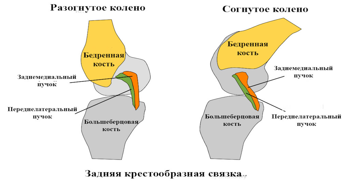 Консервативное лечение повреждений задней крестообразной связки