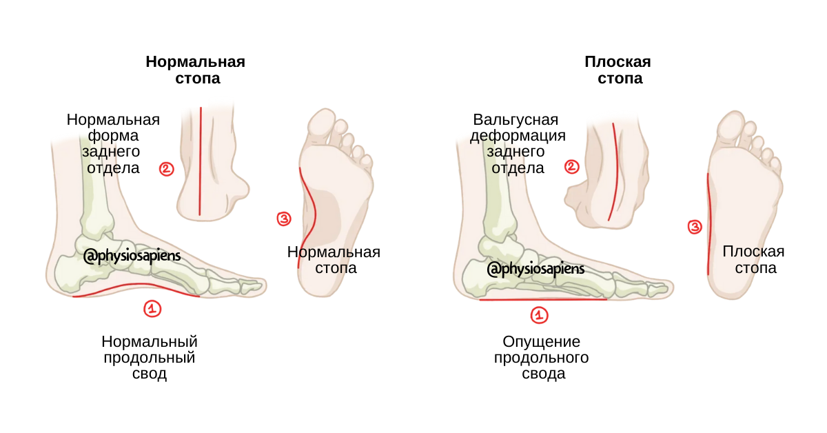 Плоскостопие