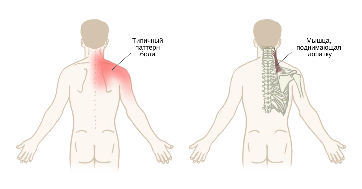 Синдром мышцы, поднимающей лопатку