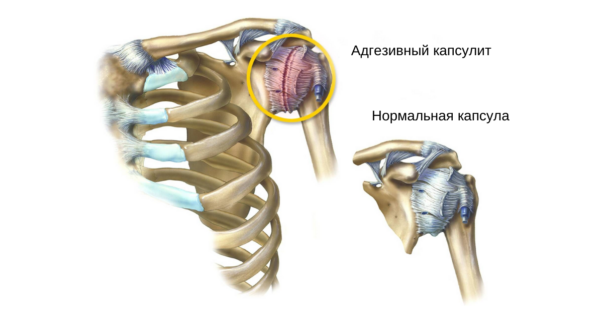 Физическая терапия при синдроме замороженного плеча