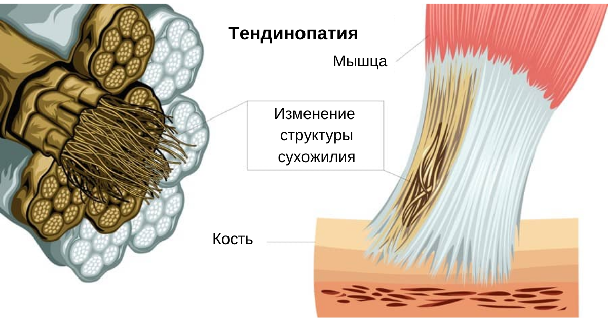 9 фактов о тендинопатиях