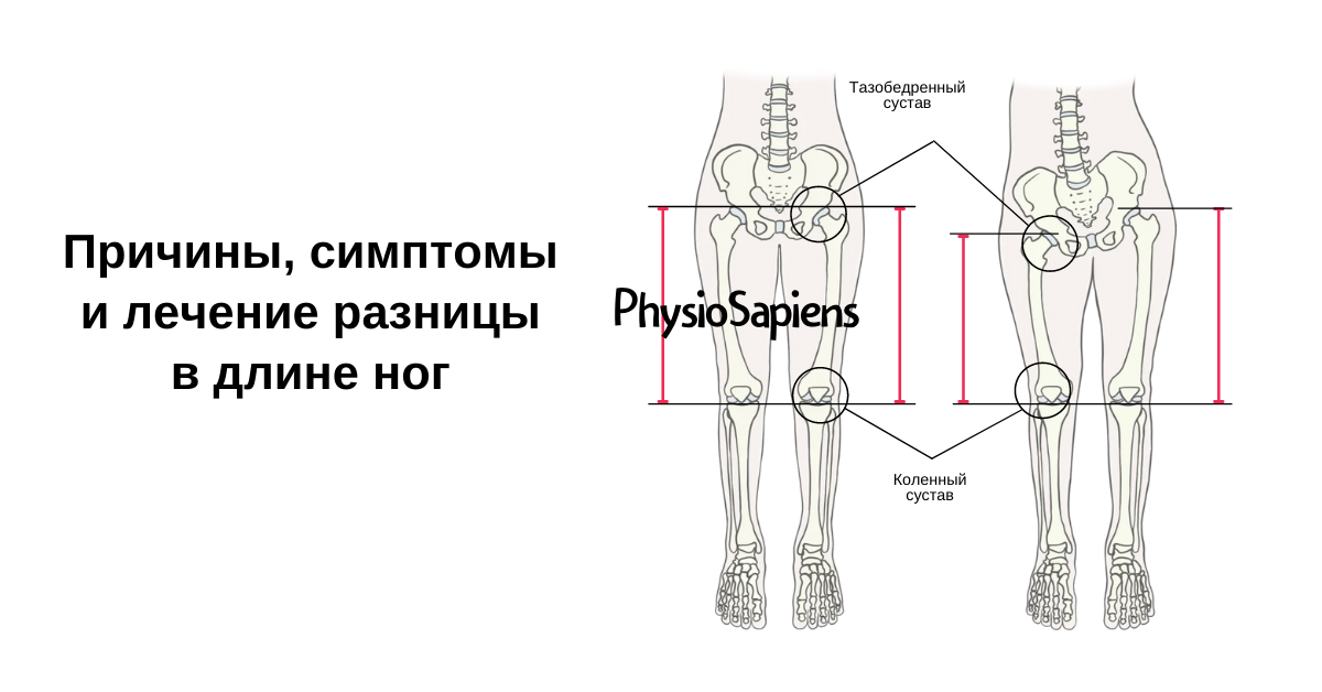 Разница в длине ног