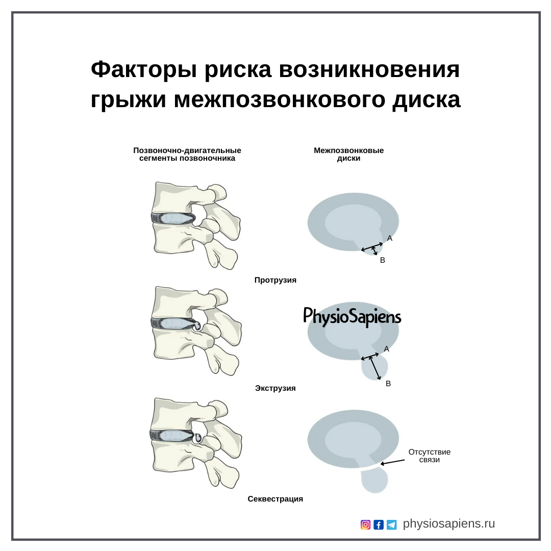 Факты и вымысел о грыжах межпозвонкового диска