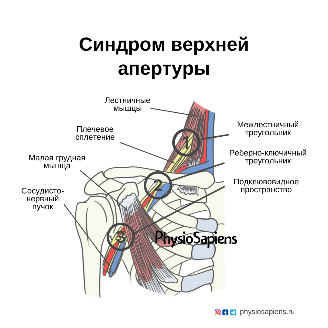 Синдром верхней апертуры