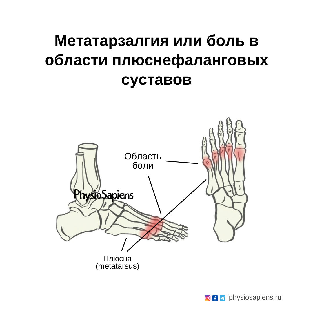 Метатарзалгия