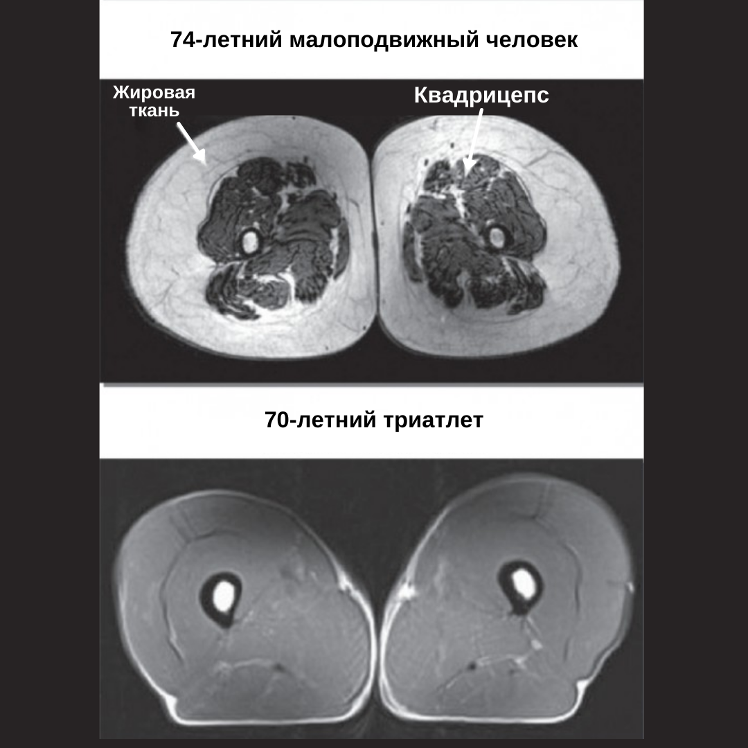 Саркопения