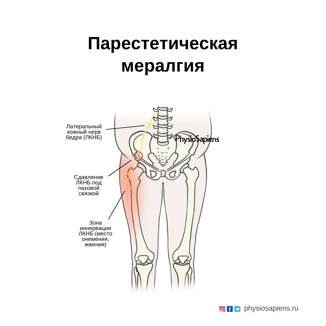 Парестетическая мералгия