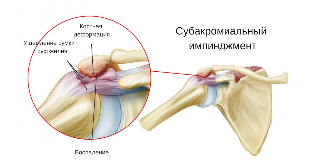 Внутренний импинджмент-синдром плечевого сустава