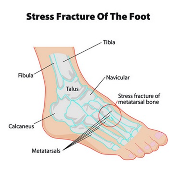 Стрессовый перелом плюсневой кости