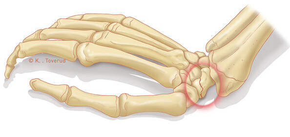 Перелом ладьевидной кости