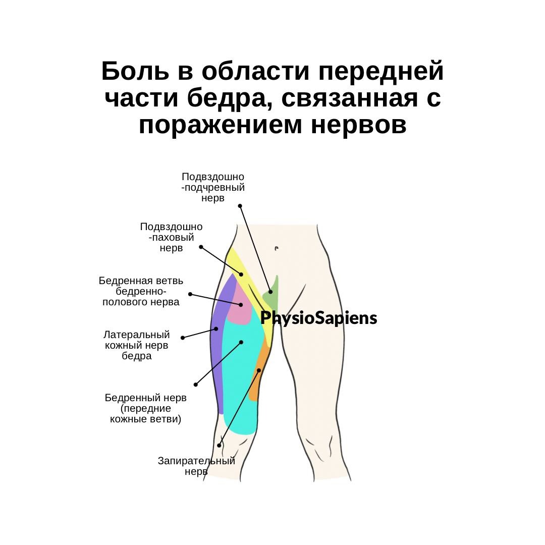 Боль в передней части бедра, связанная с поражением нервов