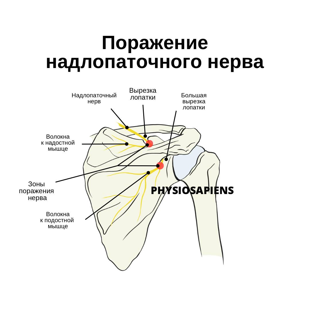 Поражение надлопаточного нерва