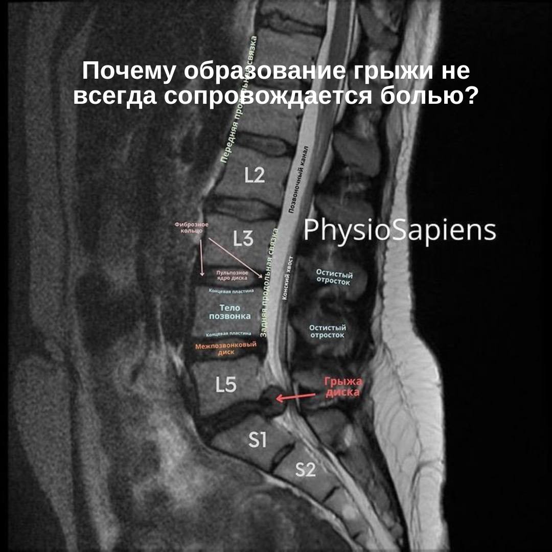 Почему образование грыжи не всегда сопровождается болью?