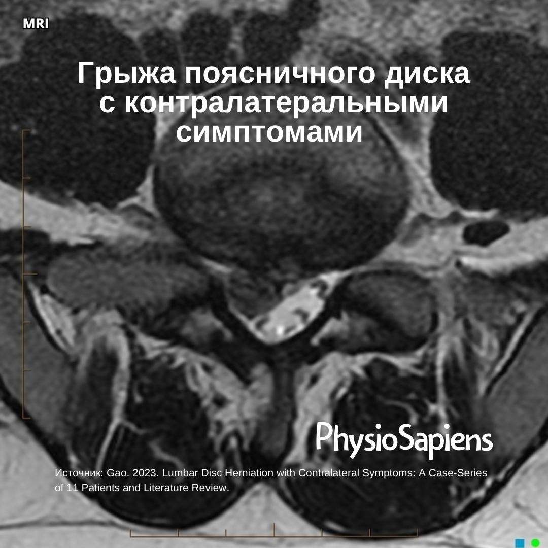 Грыжа поясничного диска с контралатеральными симптомами: как такое вообще возможно?