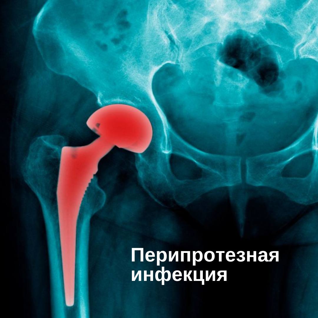 Перипротезная инфекция