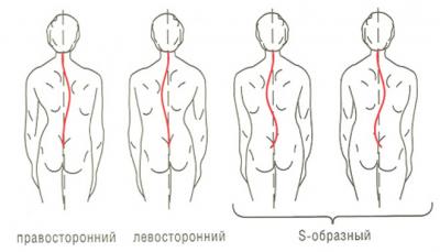 Сколиоз: виды, причины, лечение